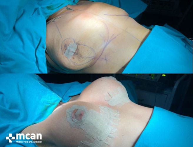 Breast lift Turkey  Mastopexy Surgeons and Costs 2024