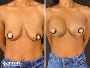 BREAST LIFT 2