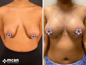 BREAST LIFT 3