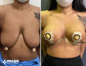 BREAST LIFT 4