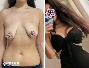 BREAST LIFT 6