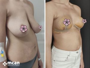 BREAST LIFT 8