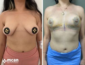 BREAST LIFT 9