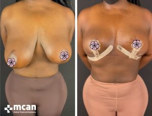 BREAST REDUCTION 1