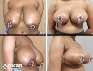 BREAST REDUCTION 10