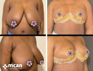 BREAST REDUCTION 11