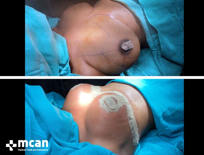Breast Reduction (Mammaplasty) in Turkey - Clinixenter