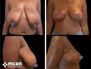 BREAST REDUCTION 2