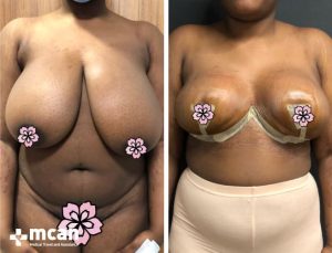 BREAST REDUCTION 3