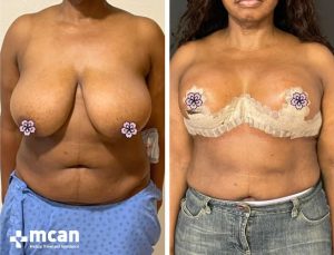 BREAST REDUCTION 4