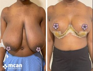 BREAST REDUCTION 8