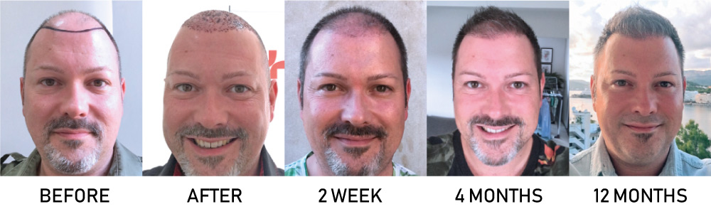 The Secret to Great Hair Transplant Results  Hair Doctor Blog