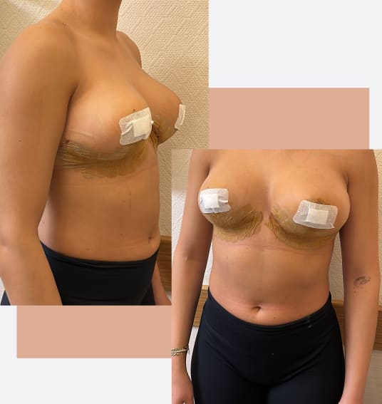 Breast Lift Mastopexy  UPMC Western Maryland Plastic Surgery