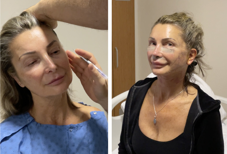 https://www.mcanhealth.com/wp-content/uploads/2023/04/facelift-what-is.jpg