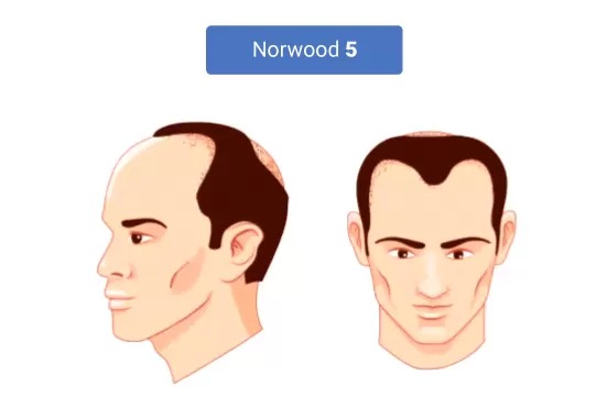 Male Pattern Baldness: What is the Cause of Male Pattern Baldness?