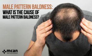 male pattern baldness