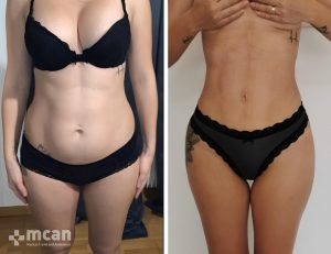 liposuction before after 10