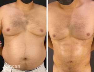 liposuction before after 11