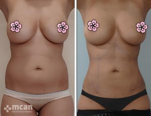 liposuction before after 13