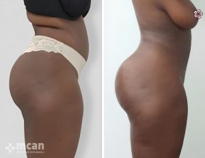 liposuction before after 14