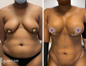 liposuction before after 4