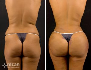 liposuction before after 5