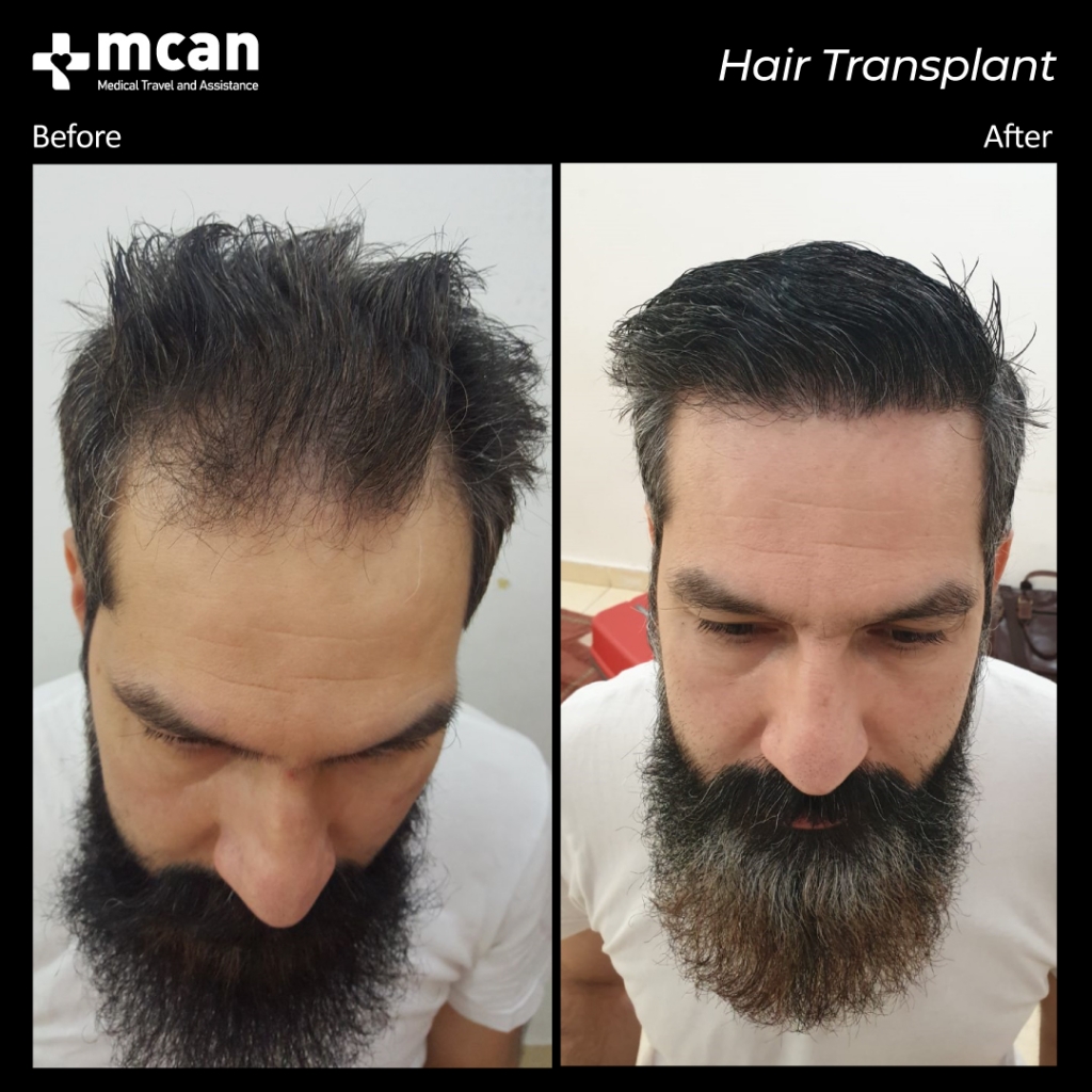 MCAN Health hair transplant before and after 2