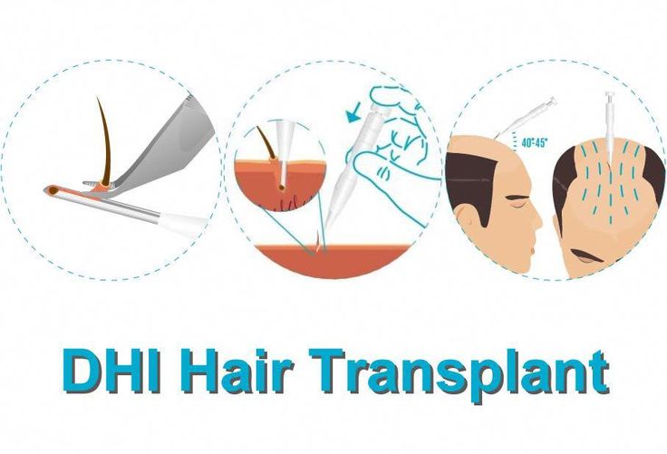 dhi hair transplant with mcan health