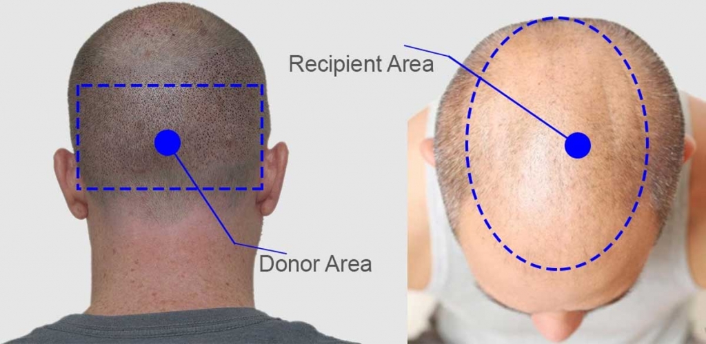 recipient and donor area in hair transplant