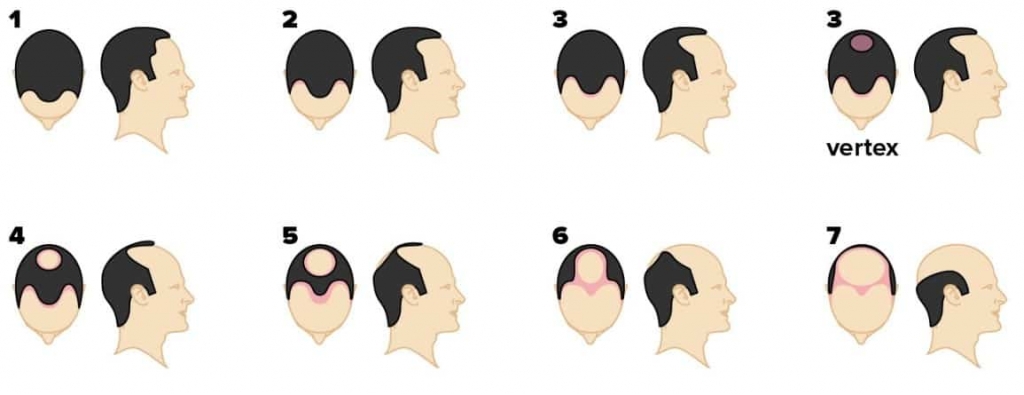 norwood scale for hair loss in men