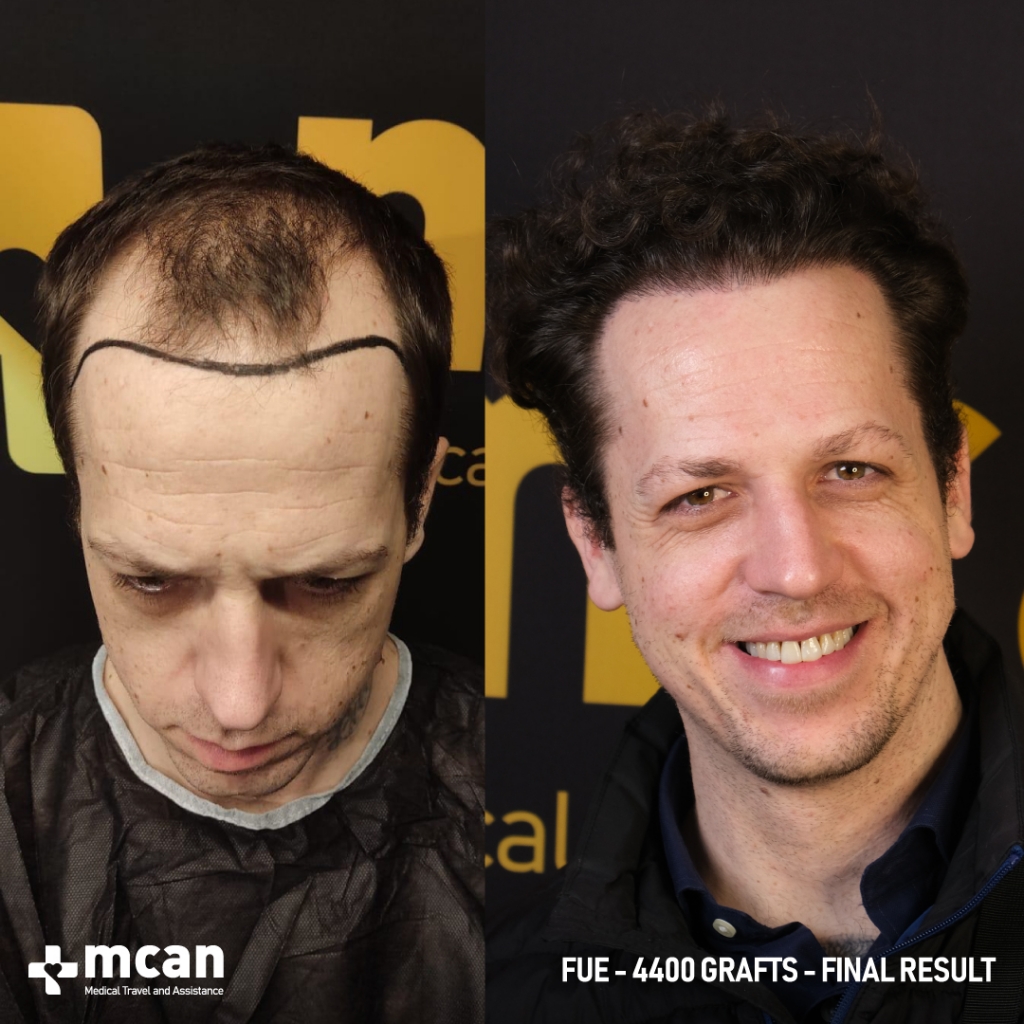 ALASTAIR CLARKE 4400 Grafts FUE Hair Transplant 12 Months Before & After