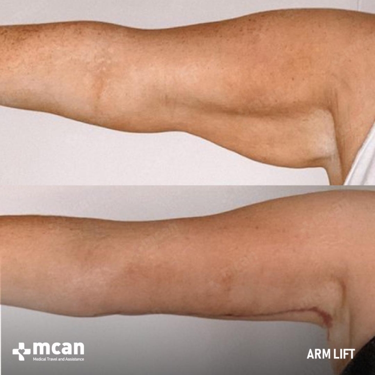 Arm Lift Before & Afters 1