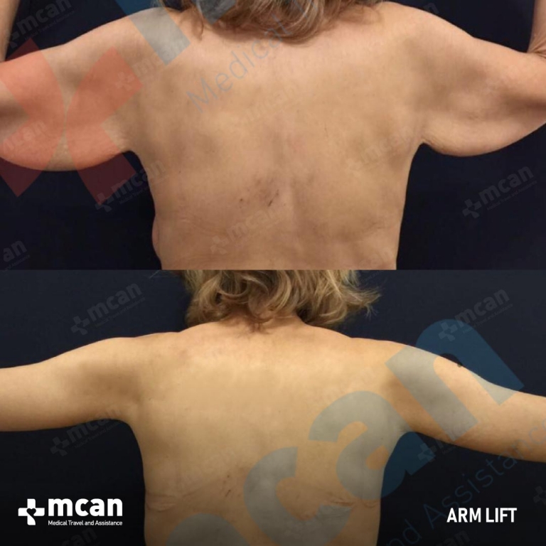 Arm Lift Before & Afters 1