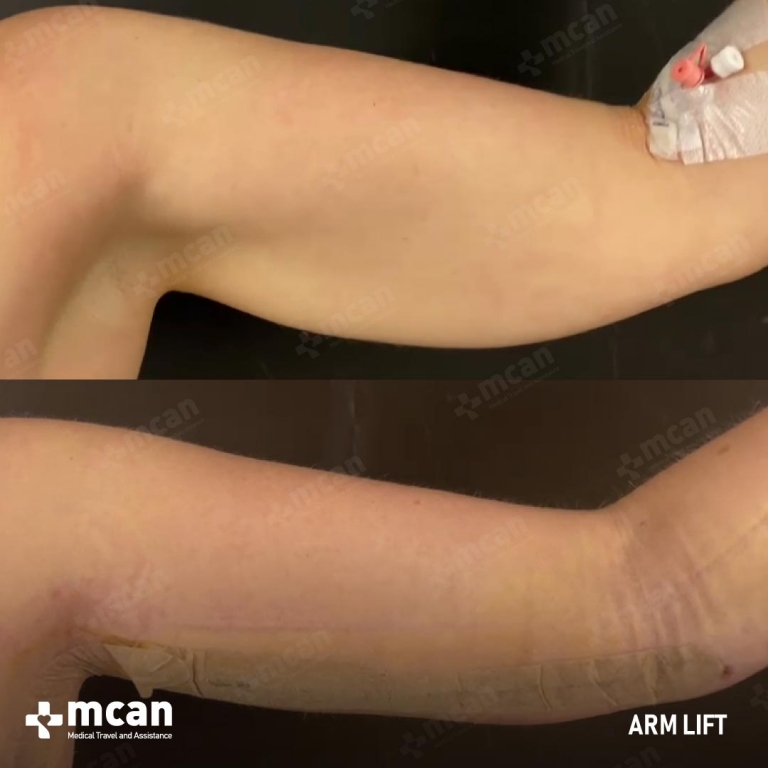 Arm Lift Before & Afters 1