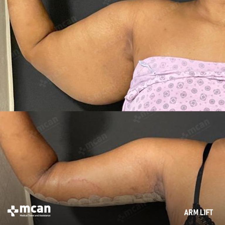 Arm Lift Before & Afters  1