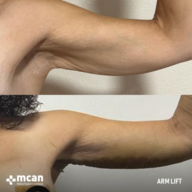 Arm Lift Before & Afters 1