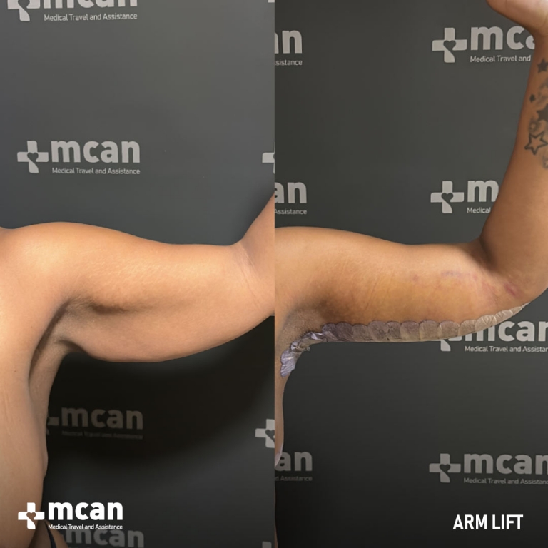 Arm Lift Before & Afters 1