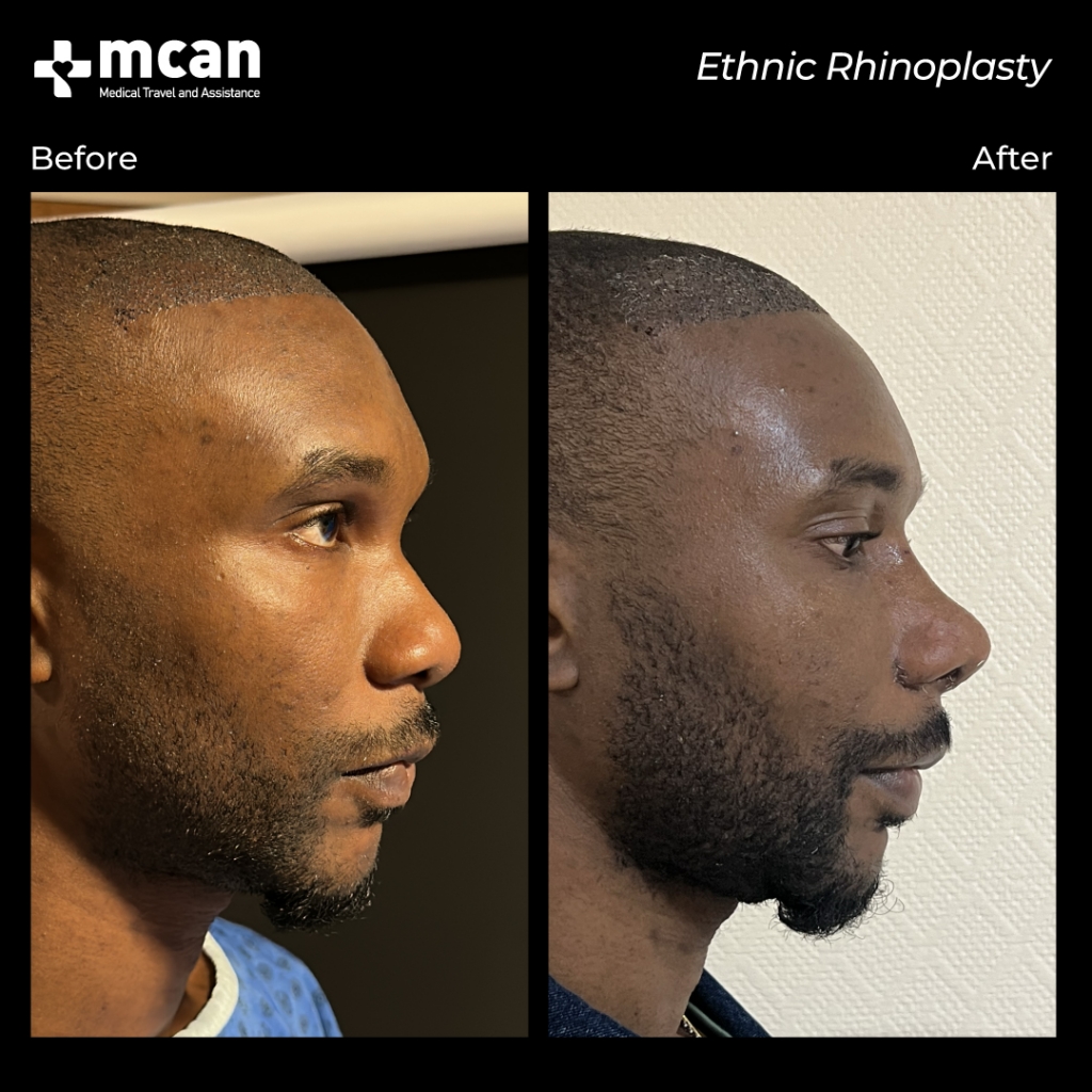 ethnic nose job before and after mcan health