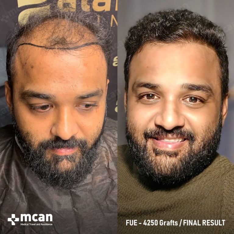 Balaji T. Before and After