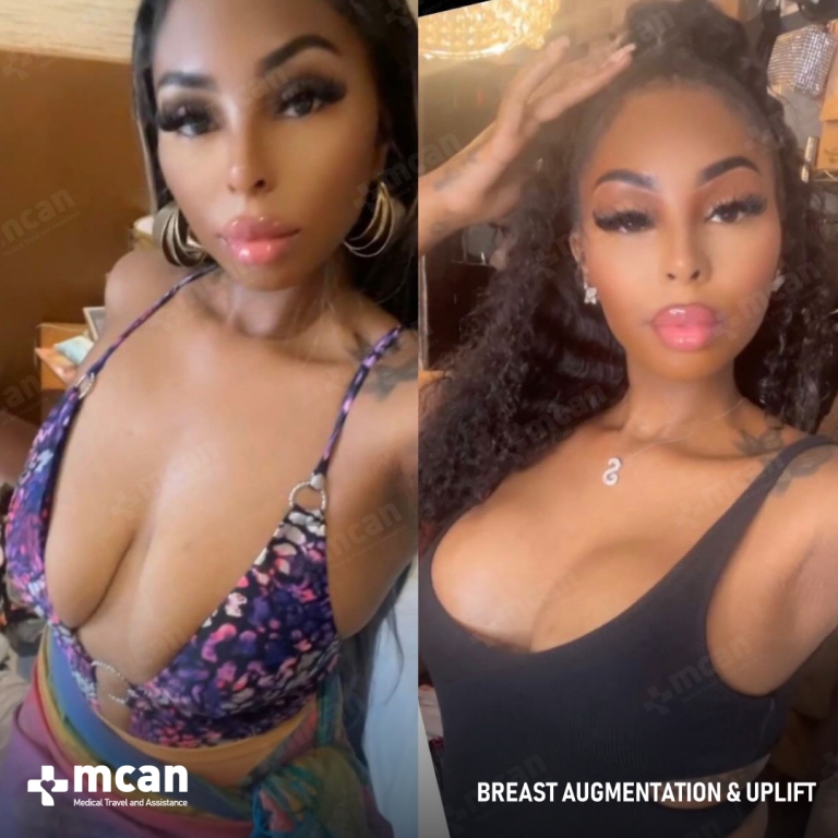 Breast Enlargement Before and After