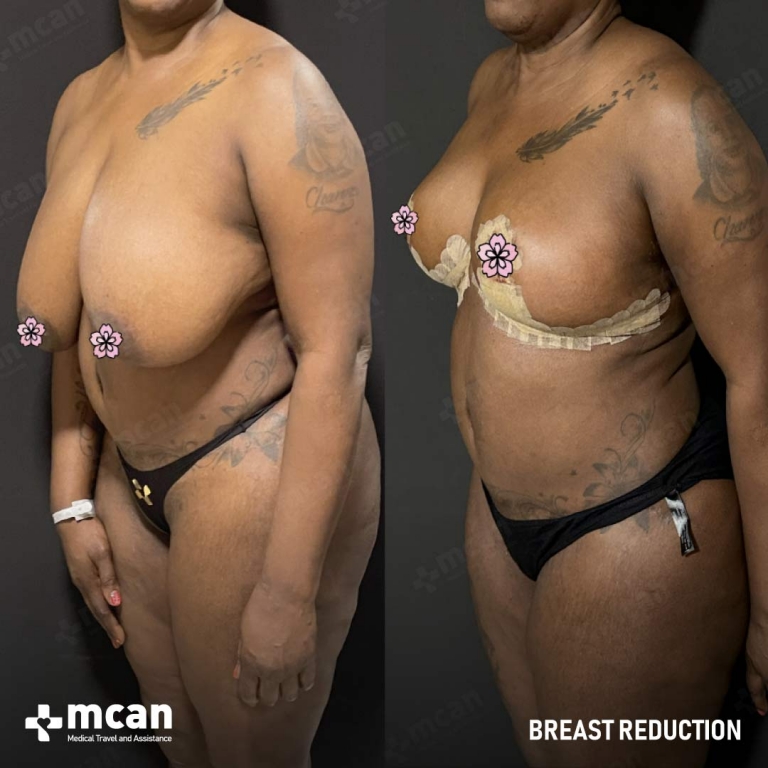 Breast Reduction Before & Afters 1