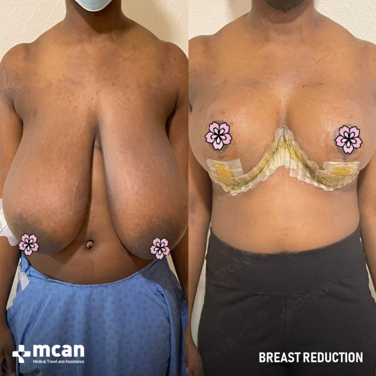 Breast Reduction Before & Afters 1