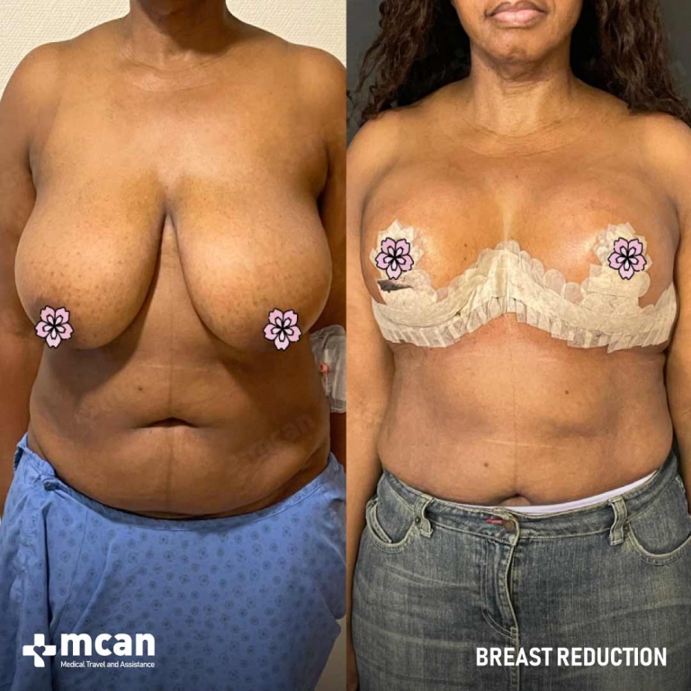 Breast Reduction Before & Afters 1