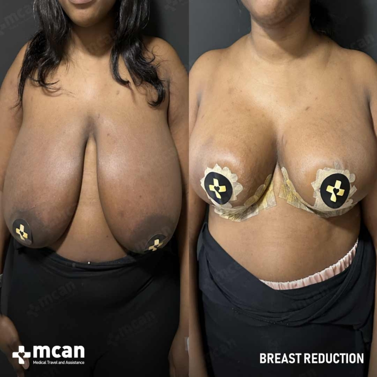 Breast Reduction Before & Afters 1