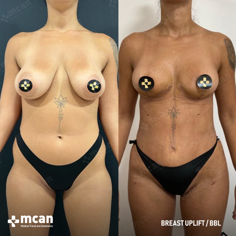 Breast Uplift Before and After