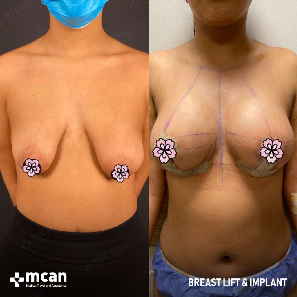 Breast Uplift Before After 3