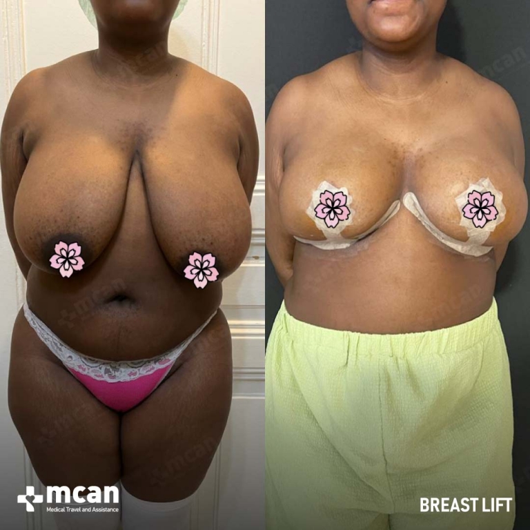 Breast Uplift Before & Afters 1