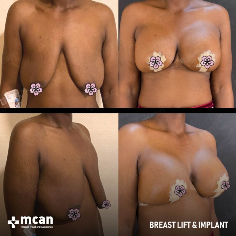 Breast Uplift Before & Afters 1