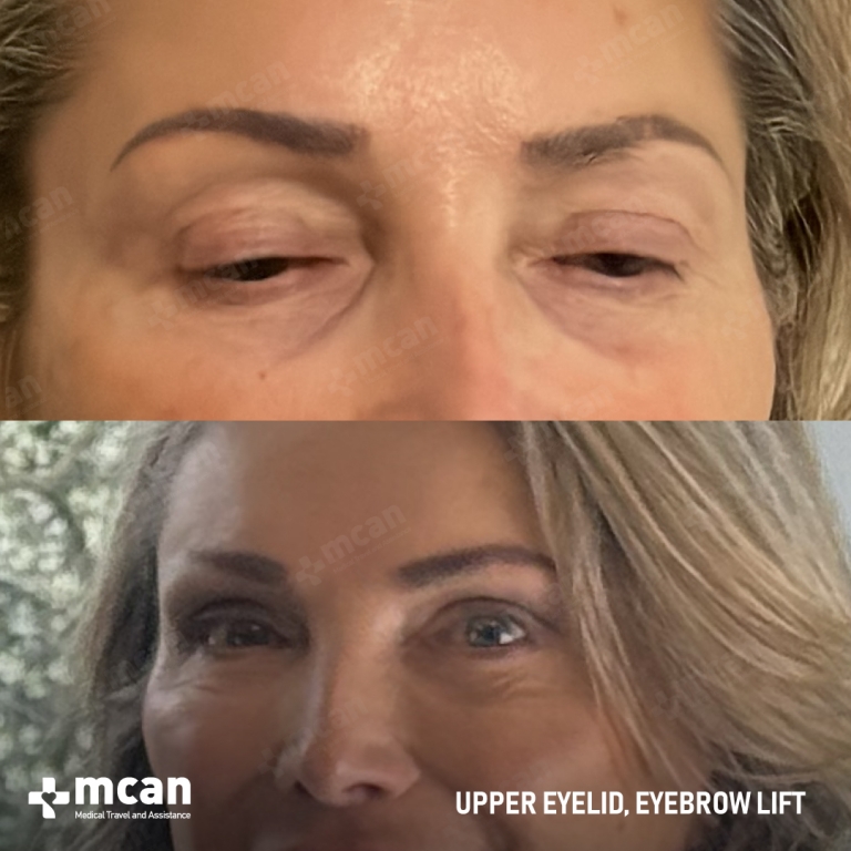 Brow Lift Before & Afters 1