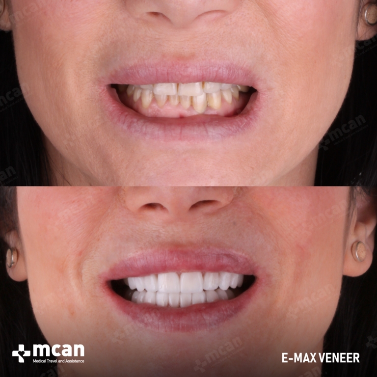 E-MAX VENEER Before and After